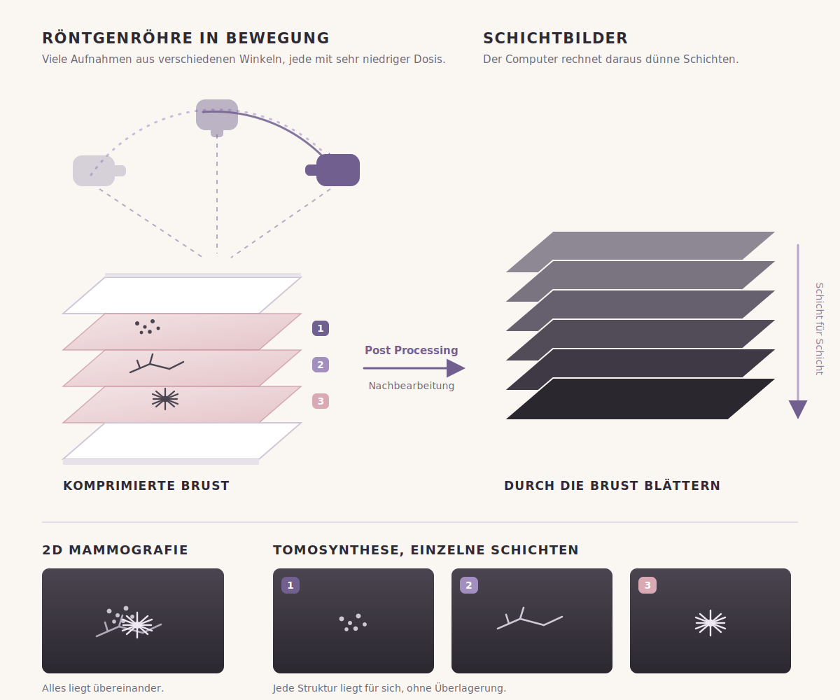 Schema der Tomosynthese: die Röntgenröhre bewegt sich im Bogen über die komprimierte Brust, aus den Aufnahmen rechnet der Computer Schichtbilder. Unten der Vergleich, links die 2D Mammografie mit allen Strukturen übereinander, rechts drei einzelne Schichten mit je einer Struktur.